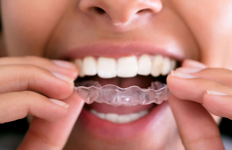 Dùng thiết bị bảo vệ miệng để hạn chế nghiến răng