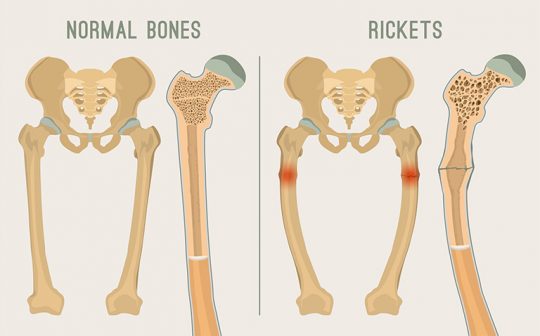 Normal,Bones,Versus,Rickets,And,Osteomalacia.,Medical,,Anatomy,And,Biology