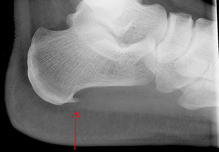 Hình ảnh X-quang cho thấy gai gót chân