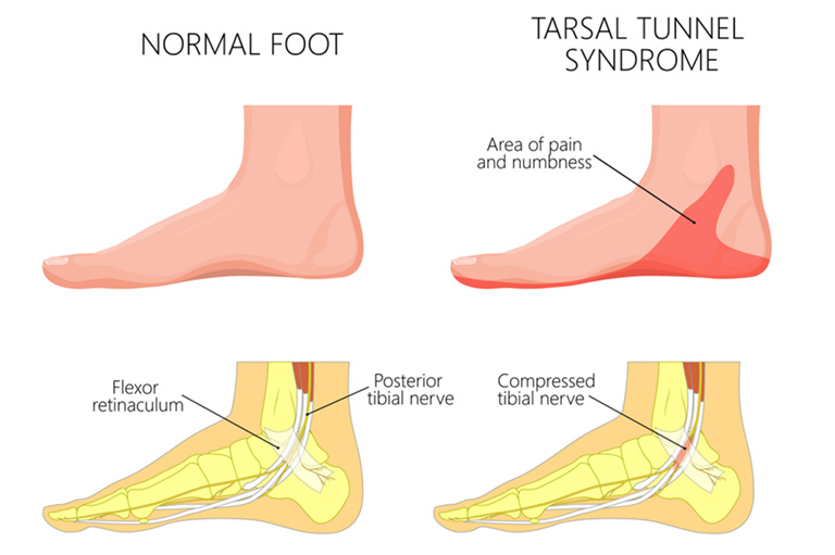Hội chứng ống cổ chân
