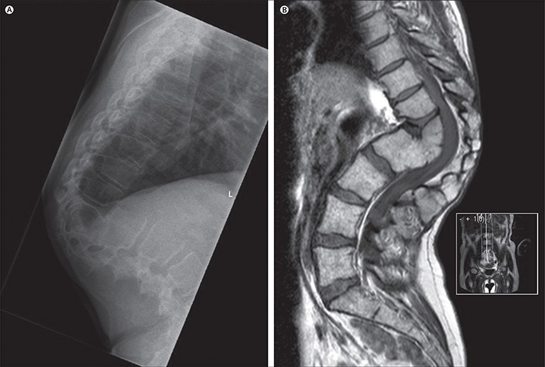 Chụp X-quang ở bệnh nhân bị lao cột sống