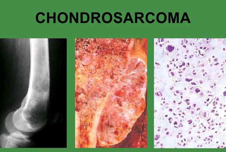 Ung thư sụn (chondrosarcoma)