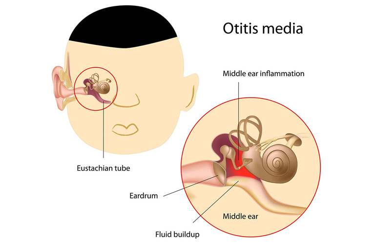 Viêm xương chũm do nhiễm trùng tai giữa không được điều trị