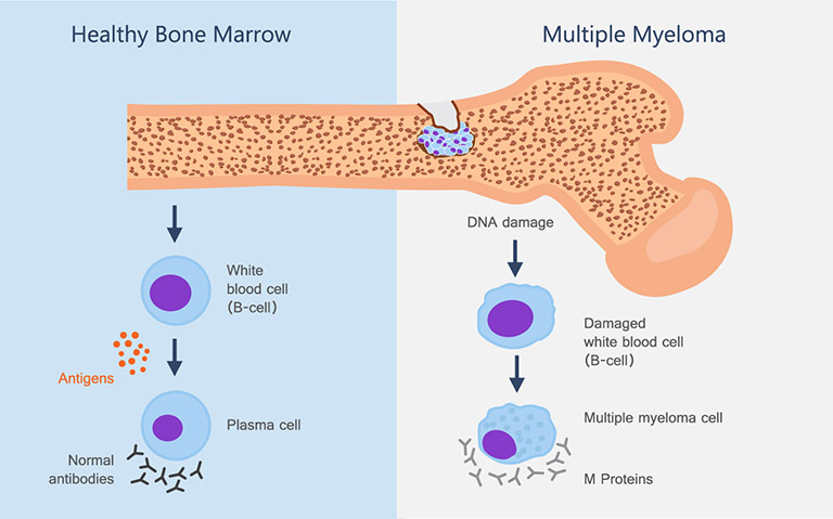 U tủy hình thành khi có một tế bào plasma bất thường trong tủy xương