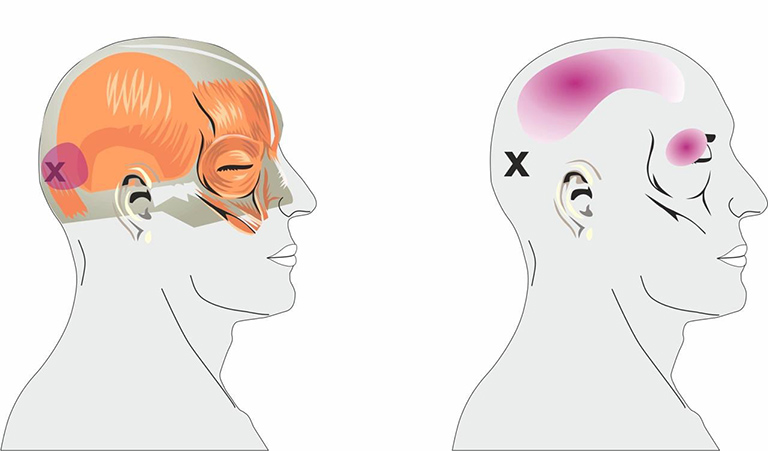 Siết chặt các cơ ở phía sau đầu và cổ có thể liên quan đến đau điều kiểm căng thẳng