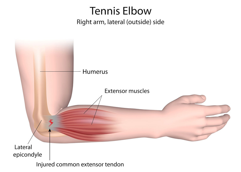Hội chứng Tennis Elbow