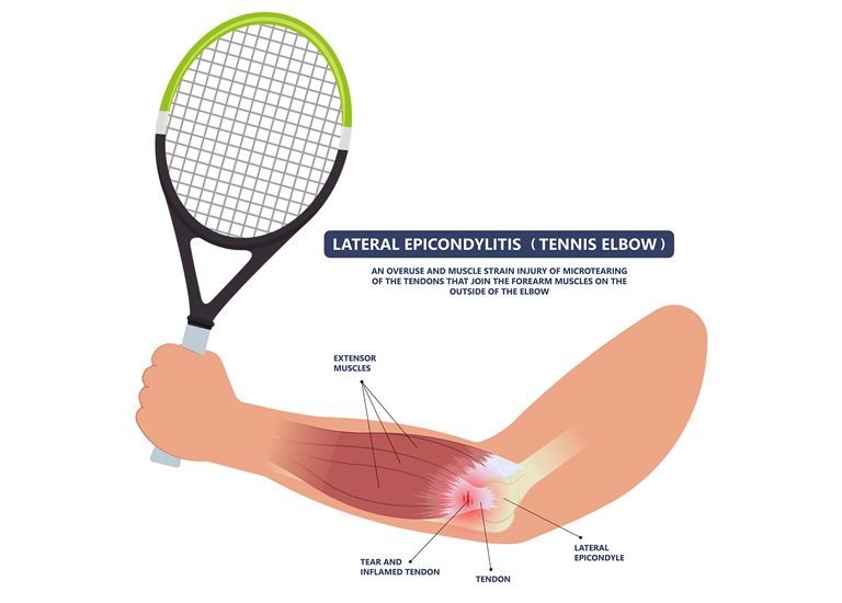 Hội chứng Tennis Elbow xảy ra do những chuyên động mạnh, lặp đi lặp lại khi chơi quần vợt