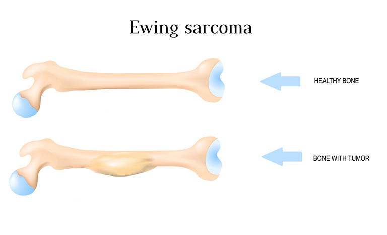 Sarcoma Ewing