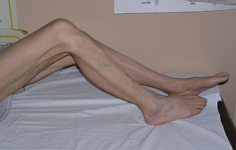 Teo cơ chân