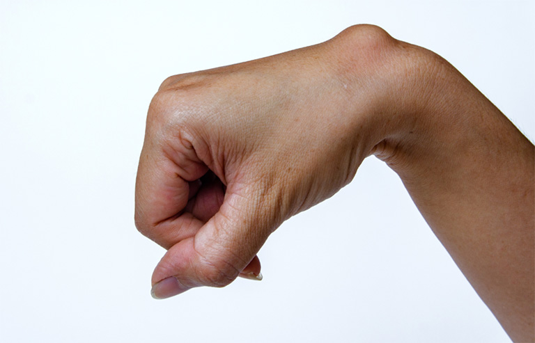 U bao hoạt dịch khớp cổ tay lớn có thể lộ rõ trên khớp