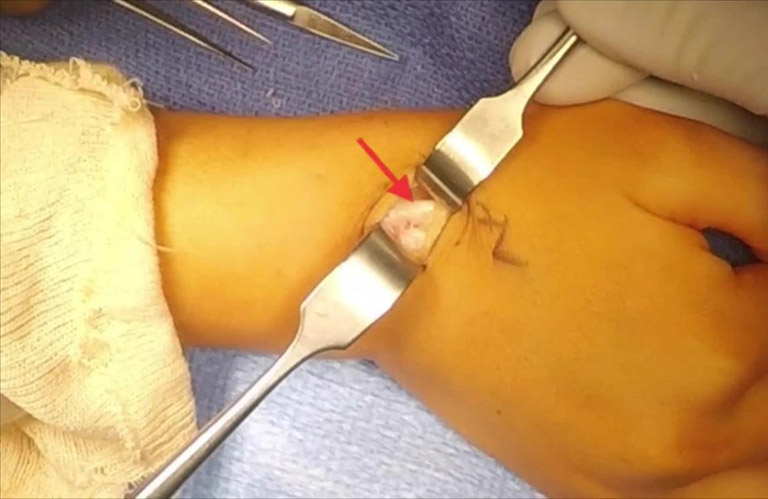 Phẫu thuật bao gồm việc cắt bỏ u nang thông qua một vết cắt nhỏ