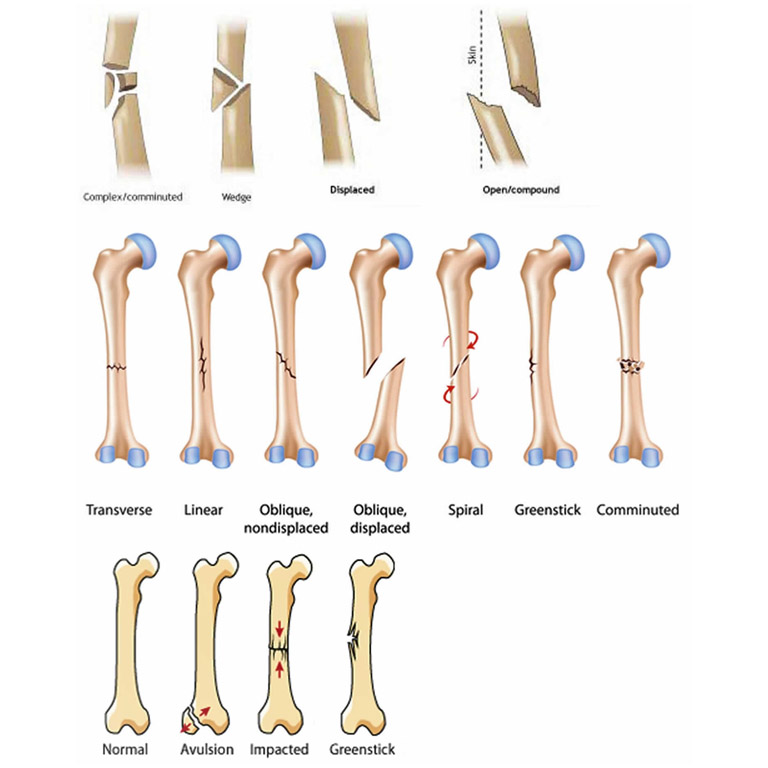 Những dạng thường gặp của gãy thân xương đùi