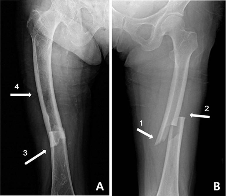 Chụp X-quang cho thấy thân xương đùi bị gãy