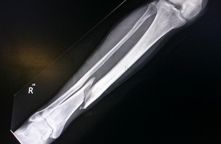 Chụp X-quang gãy xương chày