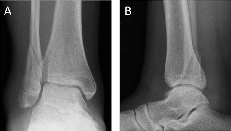Gãy xương mác gần mắt cá chân trên hình ảnh X-quang