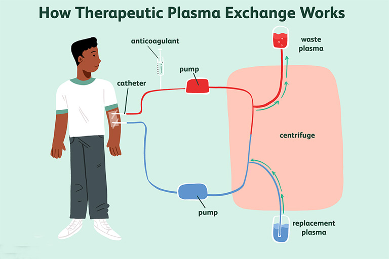 Liệu pháp trao đổi huyết tương (plasmapheresis)