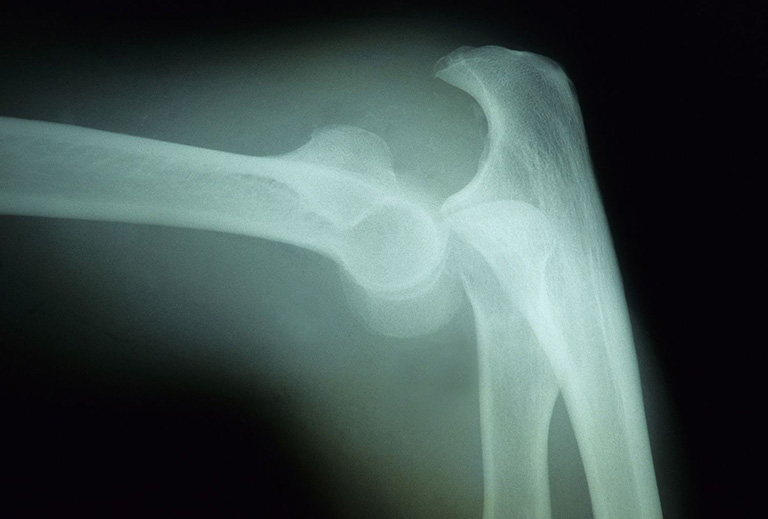 Sai khớp khuỷu tay trên hình ảnh X-quang