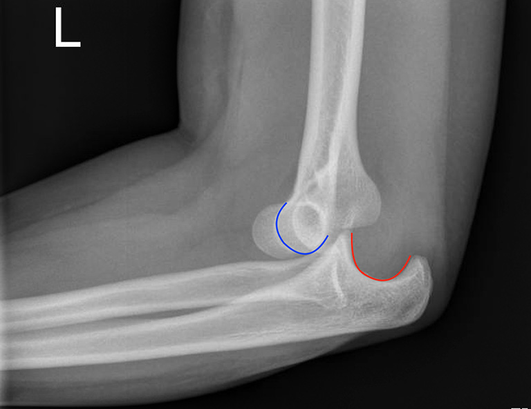 Hình ảnh X-quang cho thấy khuỷu tay bị trật khớp