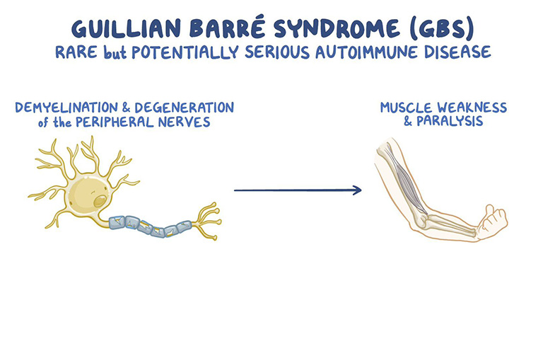 Hội chứng Guillain-Barre (GBS)