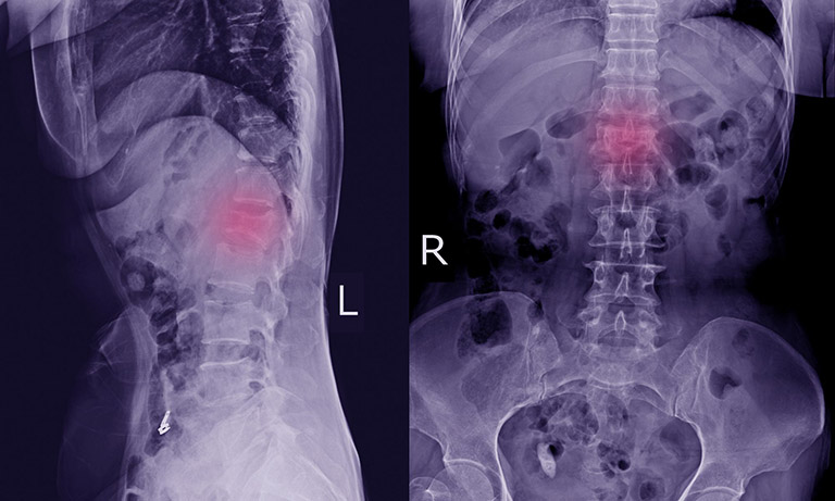 Hình ảnh X-quang cho thấy xương đốt sống bị gãy