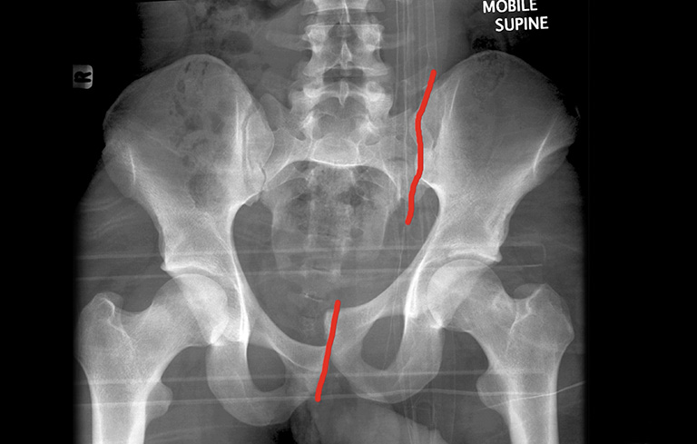 Hình ảnh X-quang cho thấy xương chậu bị gãy