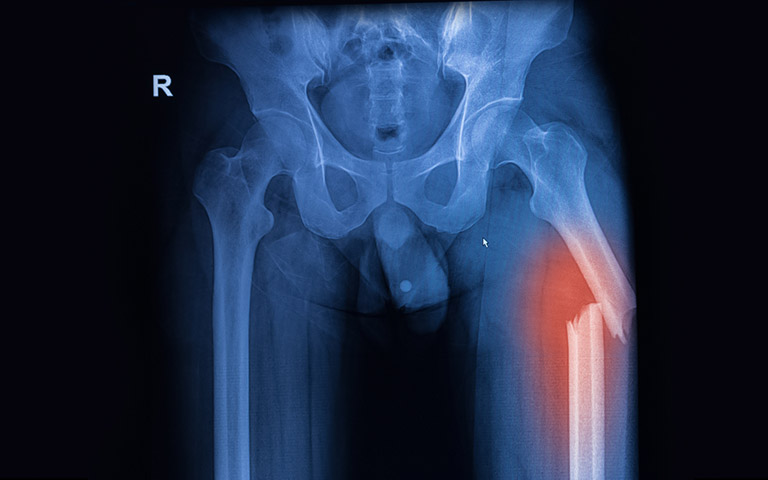 Gãy xương hở ở đùi trên hình ảnh X-quang