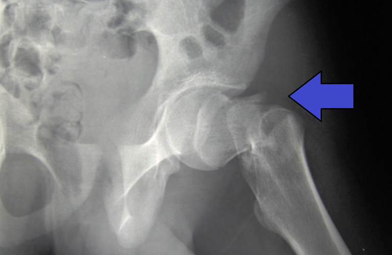 Hình ảnh X-quang cho thấy vết gãy ở vùng liên mấu chuyển