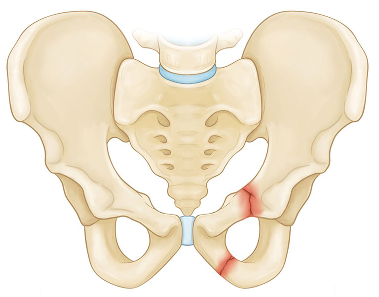 Gãy xương kín thường xảy ra ở xương chậu