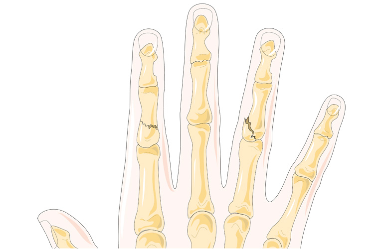 Hình ảnh gãy xương ngón tay theo mô hình xoắn ốc và gãy xương nội khớp
