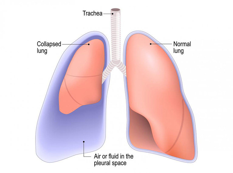 Xương sườn bị gãy hoàn toàn có thể làm thủng phổi 