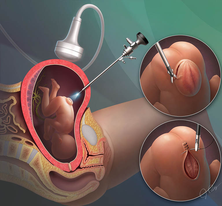 Phẫu thuật trước khi sinh