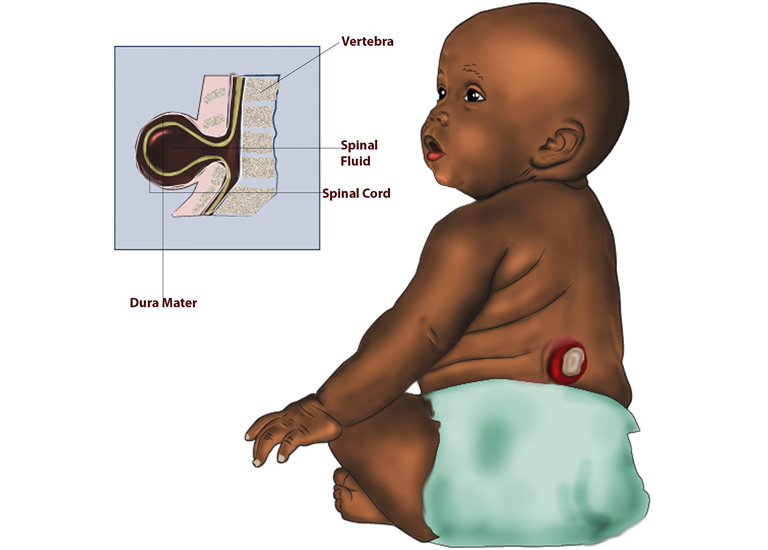 Xuất hiện một khối u hoặc túi nhô ra khỏi lưng em bé