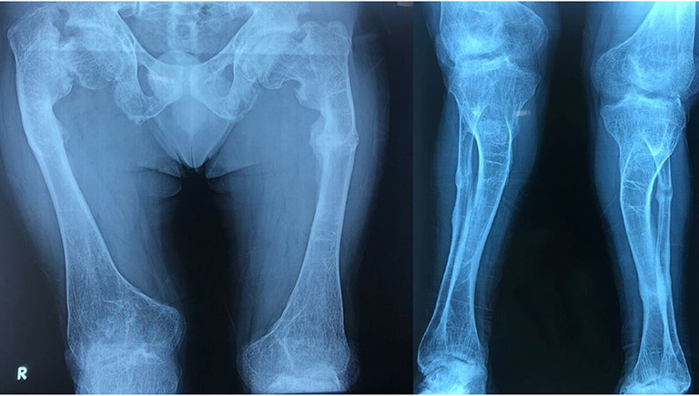 Chụp X-quang xương