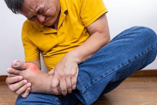 Dấu hiệu đau gout dữ dội nhiều người đang phải chịu đựng