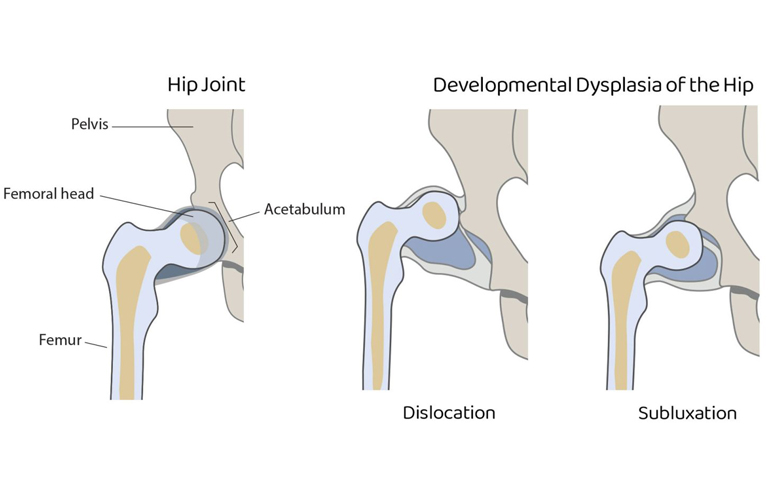 Loạn sản xương hông phát triển (DDH)