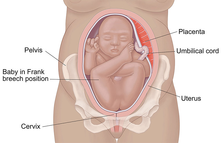 Trẻ được sinh ra ở tư thế ngôi mông