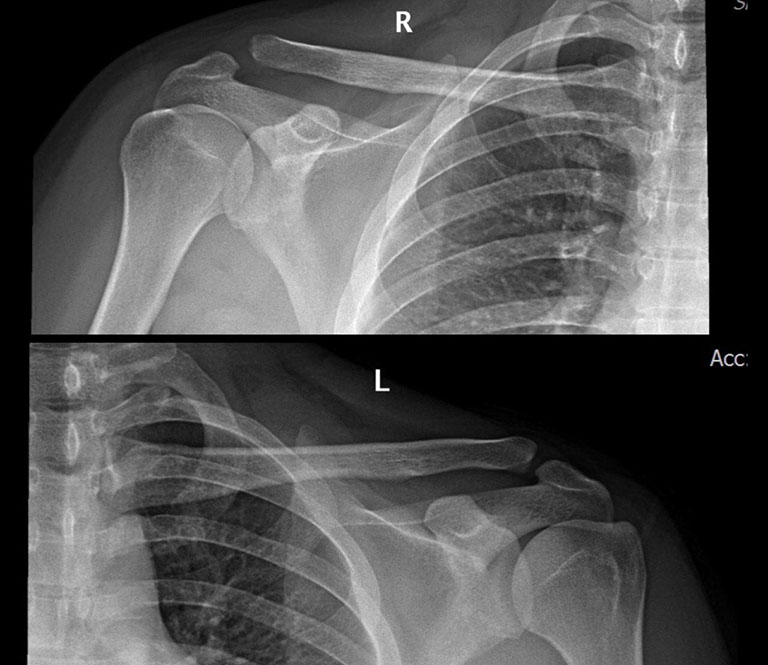 Hình ảnh X-quang cho thấy đầu ngoài xương đòn tách khỏi ổ khớp